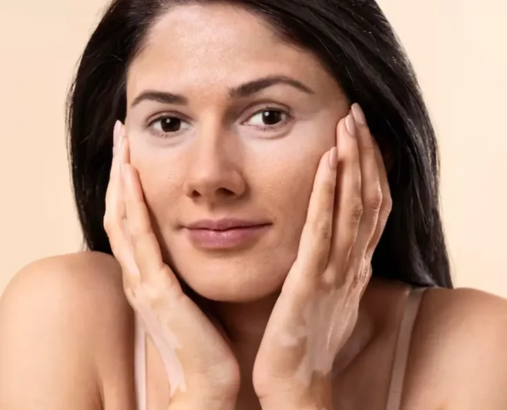 Pigmentation and skin tone correction at Wahat Alyasmeen Medical Center